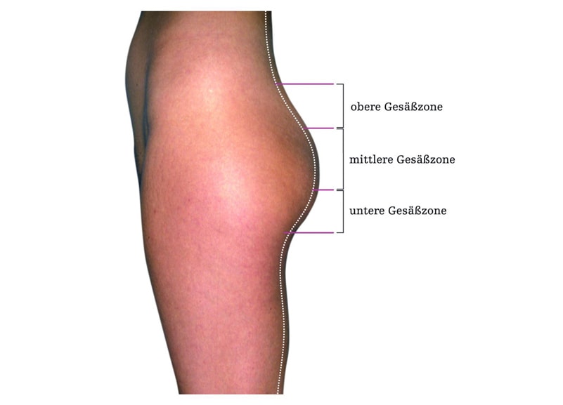 Die Volumenverteilung ist für ein optimales Ergebnis einer Gesäßstraffung ausschlaggebend.
