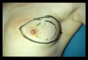 Geplanter Schnitt einer Brustamputation wegen Brustkrebs