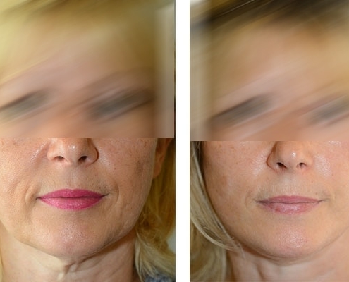 vor und nachher Beispiel einer Facelift Operation