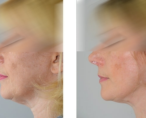 Beispiel einer Facelift Operation