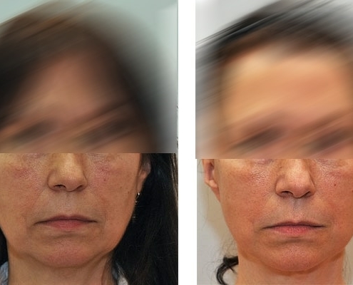 Beispiel eines Facelift vor und nach der Operation