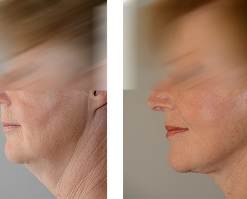 Vorher Nachher Beispiel einer Facelift Operation 