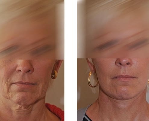 Beispiel vor und nach einer Facelift Operation 