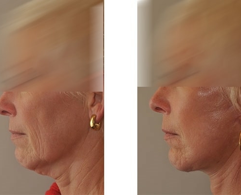 Vorher Nachher Beispiel einer Facelift Operation