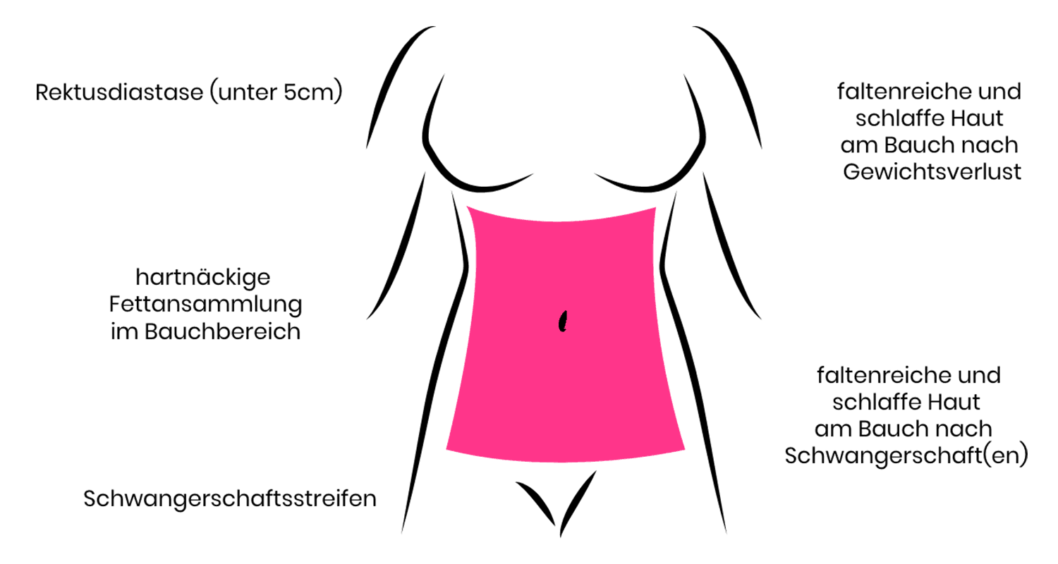 Bei der Bauchstraffung wird meist faltenreiche und schlaffe Haut am Bauch entfernt.