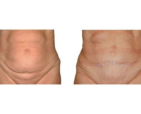 Bauchdeckenstraffung mit begleitender Liposuction