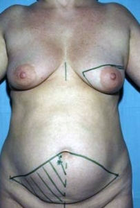 Brustrekonstruktion mittels Eigengewebe vom Bauch 