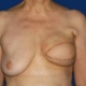 Zustand nach der Entfernung und sofortigen Rekonstruktion der Brust nach Brustkrebs.