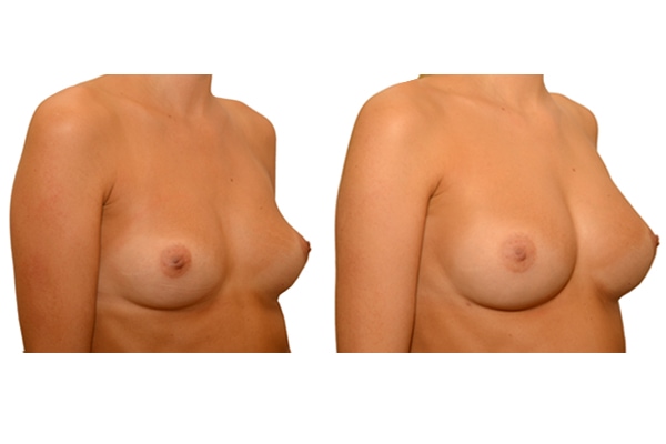 Ergebnis nach einer natürlichen Brustvergroesserung nach 3 Eigenfetttransplantationen.