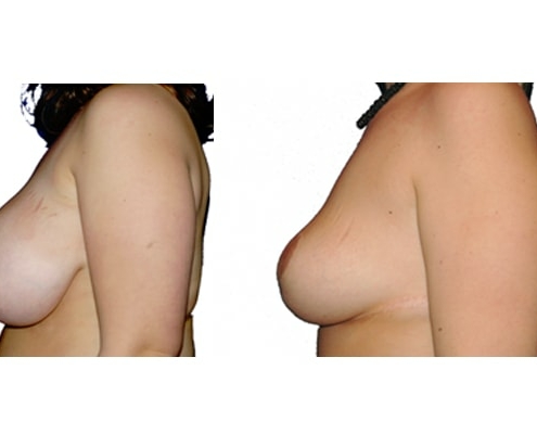 Symmetrieangleichung und Brust Reduktionsplastik von der Seite links