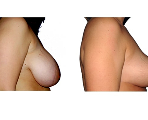 Symmetrieangleichung und Brust Reduktionsplastik von der Seite rechts