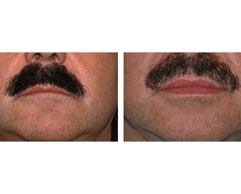 Eigenfett zur Lippenvergrößerung