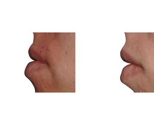 Eigenfett zur Lippenvergrößerung