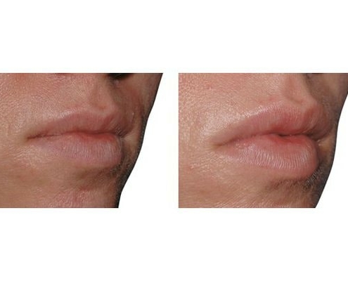 Eigenfett zur Lippenvergrößerung