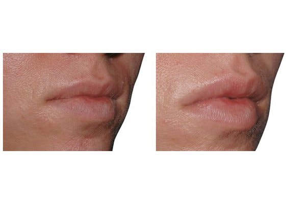 Eigenfett zur Lippenvergrößerung