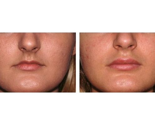 Eigenfett zur Lippenvergrößerung