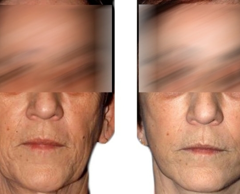 Beispiel einer Facelift Operation