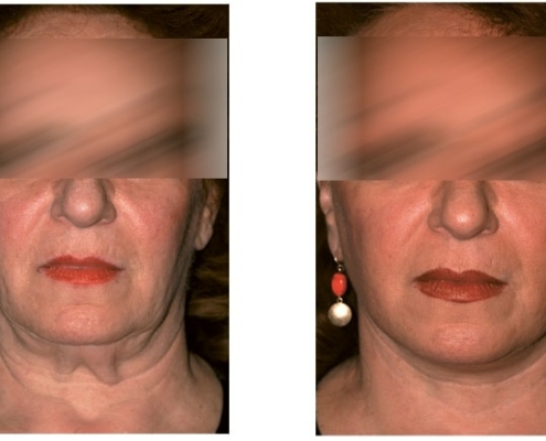 Beispiel einer Facelift Operation