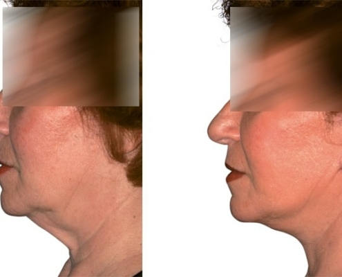 Beispiel einer Facelift Operation