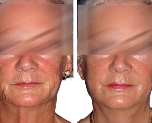 Beispiel einer Facelift Operation