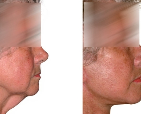Beispiel einer Facelift Operation