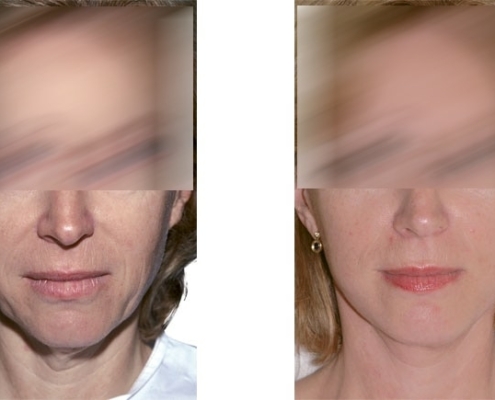 Beispiel einer Facelift Operation