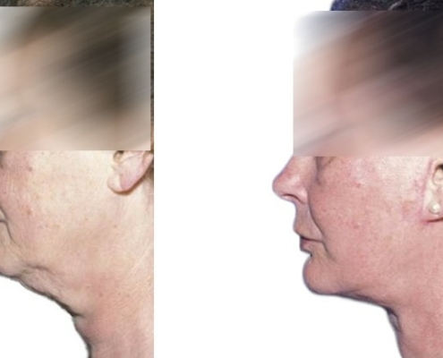 Beispiel einer Facelift Operation