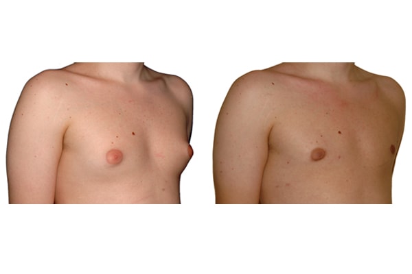 Gynecomastia - Wikipedia