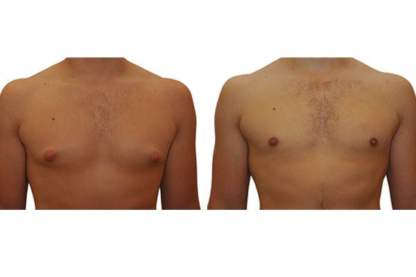 Gynecomastia prosztatagyulladás