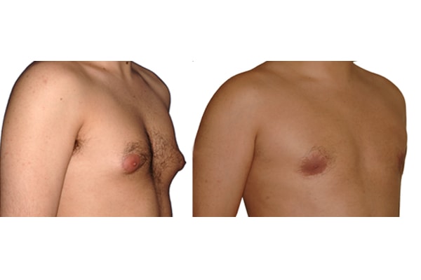 Bei der Gynäkomastie Operation wird Brustdrüsengewebe abgesaugt.