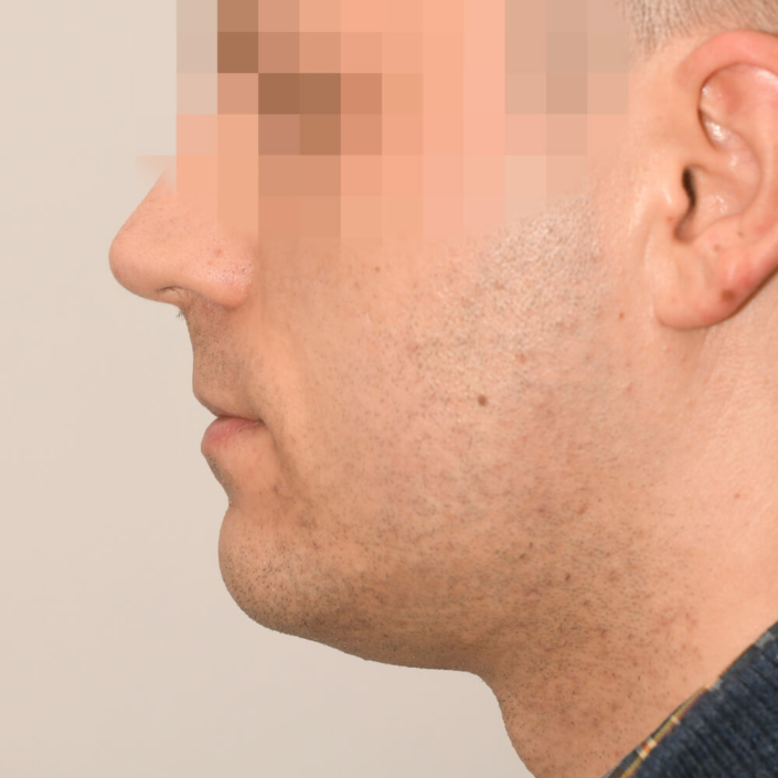 Kinnkorrektur Fliehendes Kinn Dr. Edvin Turkof Wien 1060