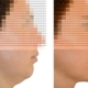 Kinn Op mit Kinnvergrösserung durch Silikonimplantat.