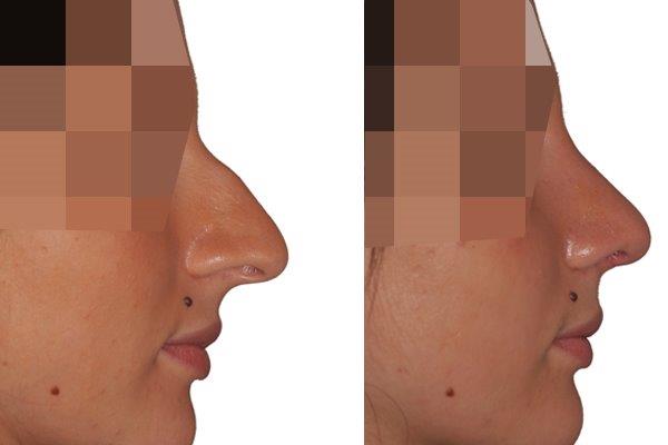 Seitenansicht vor und nach der Nasenkorrektur.