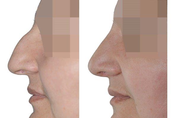 Seitenansicht einer Nasenkorrektur mit Höcker Begradigung.