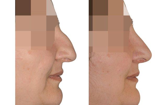 Seitenansicht einer Nasenkorrektur mit Höckerentfernung vor und nach der Operation.