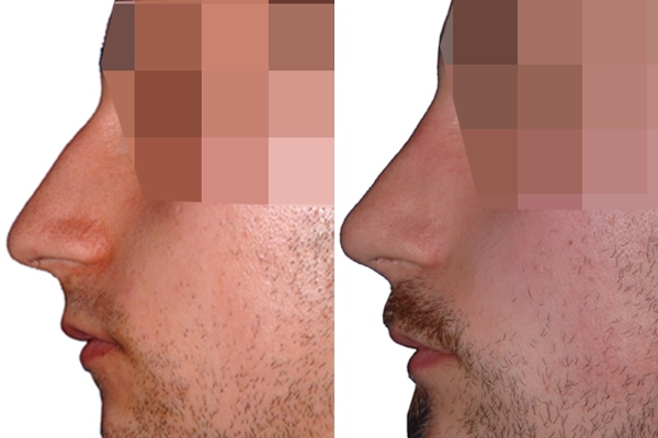 Korrektur eines Höckers vor und nach der Nasenkorrektur