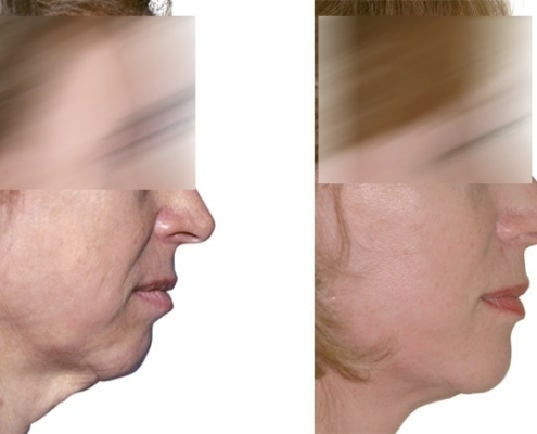 Beispiel einer Facelift Operation