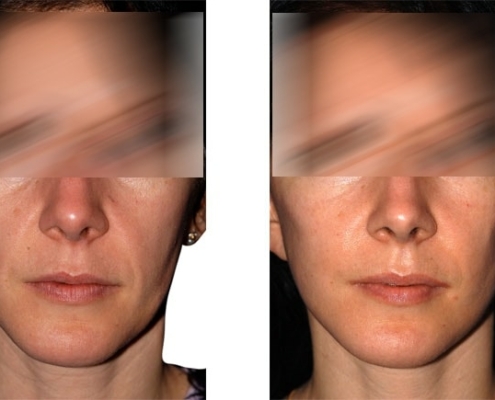 Beispiel einer Facelift Operation