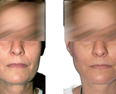 Beispiel einer Facelift Operation