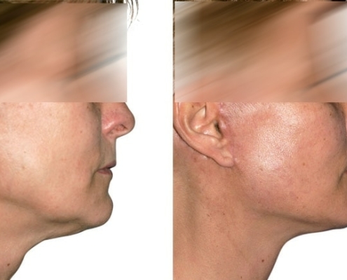 Beispiel einer Facelift Operation