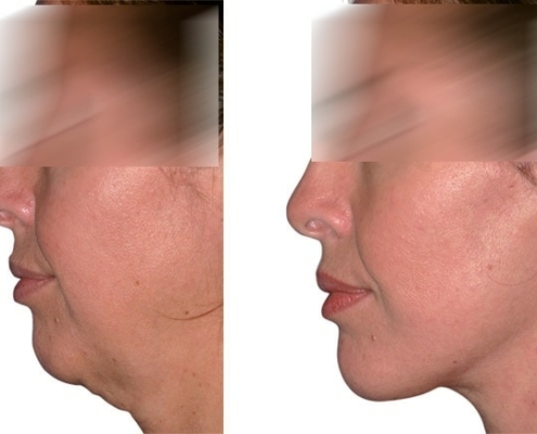 Beispiel einer Facelift Operation