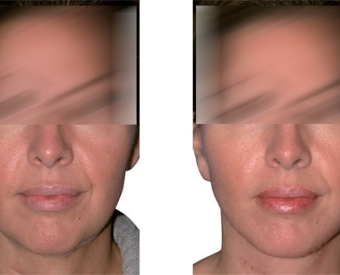 Beispiel einer Facelift Operation