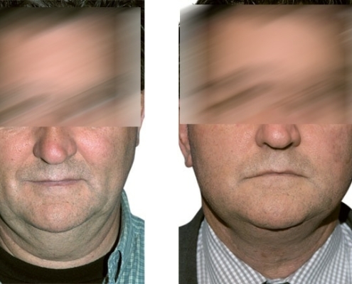 Beispiel einer Facelift Operation