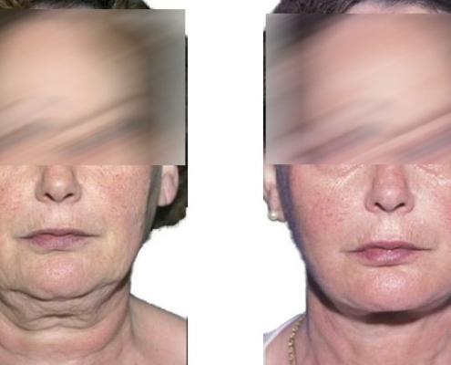 Beispiel einer Facelift Operation
