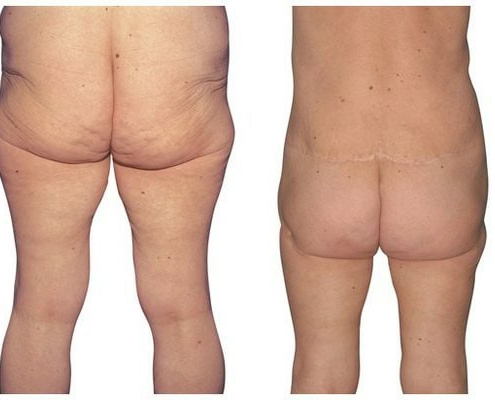 Bodylift - Gesäßstraffung Ergebnis