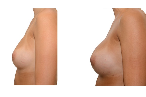 Nach 3 Brustvergrößerungen mit Eigenfett und PRP Anreicherung