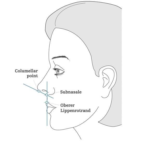 Bei einer Nasenverkleinerung wird Knorpel- und auch Knochengewebe abgetragen.