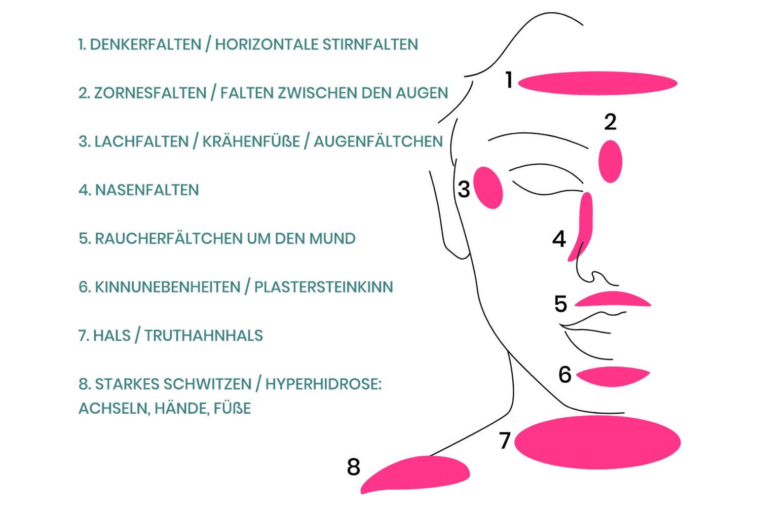 Die häufigsten Einsatzgebiete von Botulinumtoxin sind Stirn, Zornesfalte, Nasolabialfalte und Lachfalten.