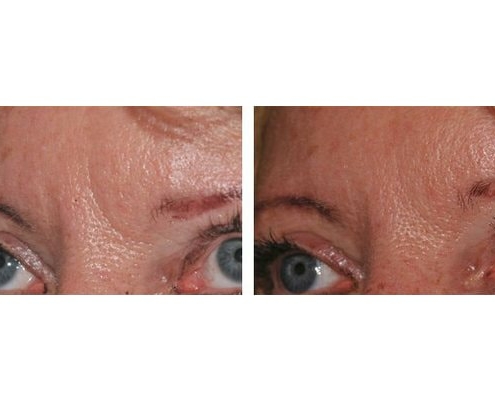 Botox zur Behandlung der Zornesfalten