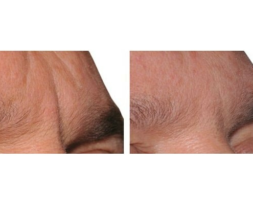 Botox zur Behandlung der Zornesfalten